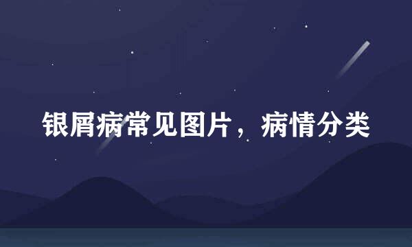 银屑病常见图片，病情分类