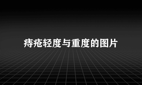 痔疮轻度与重度的图片