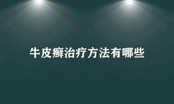 牛皮癣治疗方法有哪些